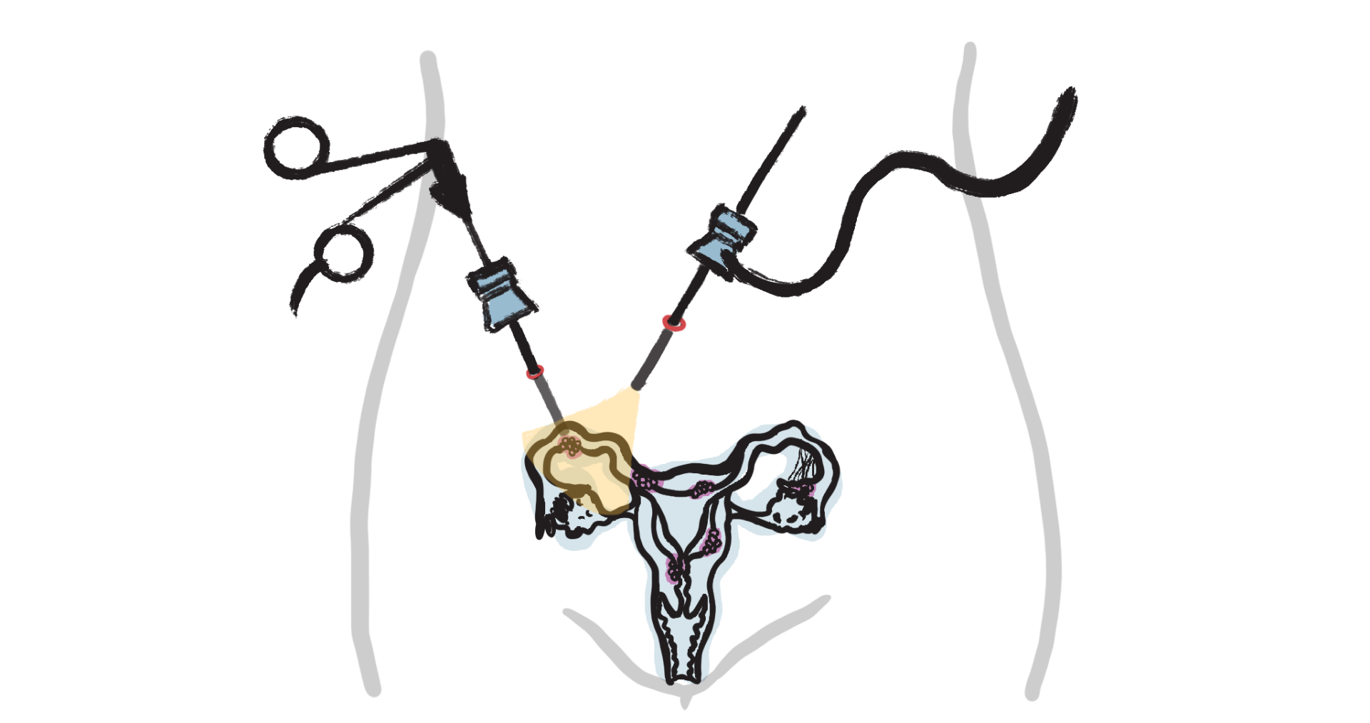 Endo_Diagnose_Laparoskopie